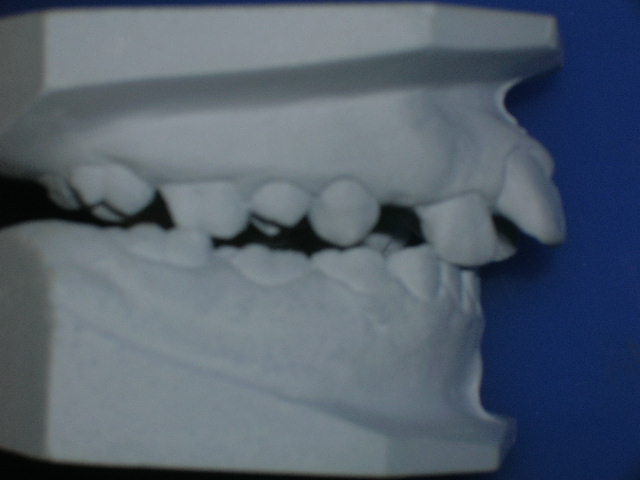 Bionator