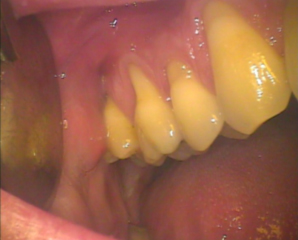 Abrasion