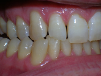 Abrasion
