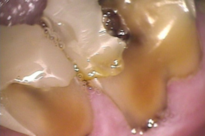 Erosion Abrasion