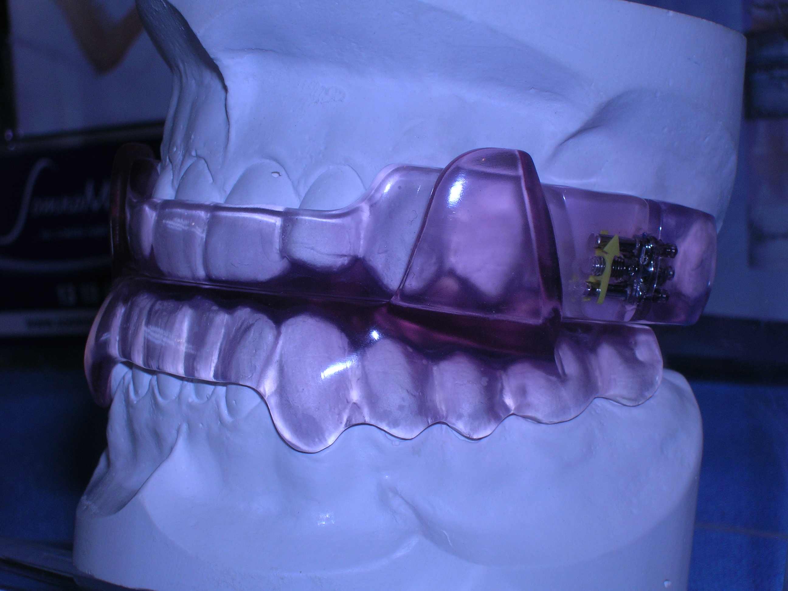 Protrusionsschiene Schnarcherschiene