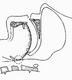 Schnarchtherapie
