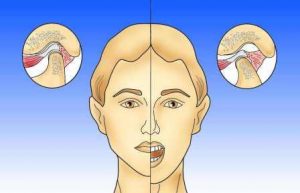 Céphalées, bruxisme, douleurs du visage | Dr. Kares – Cabinet dentaire